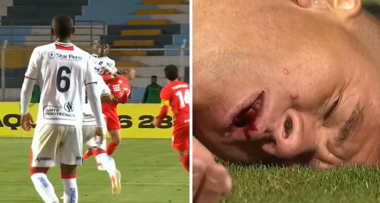 Jugador recibió brutal codazo y perdió tres dientes en Perú.
