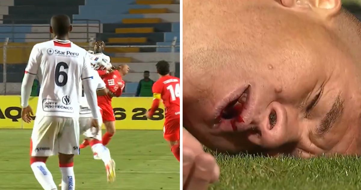 Jugador recibió brutal codazo y perdió tres dientes en Perú.