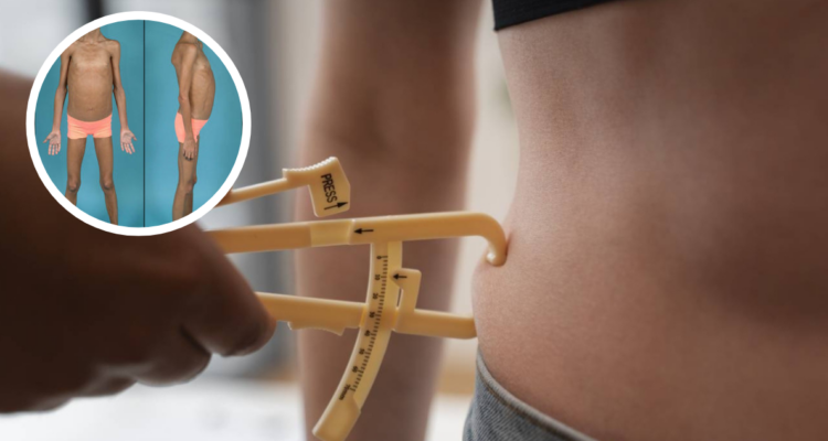 Lipodistrofia: el raro trastorno genético que se confunde con la obesidad