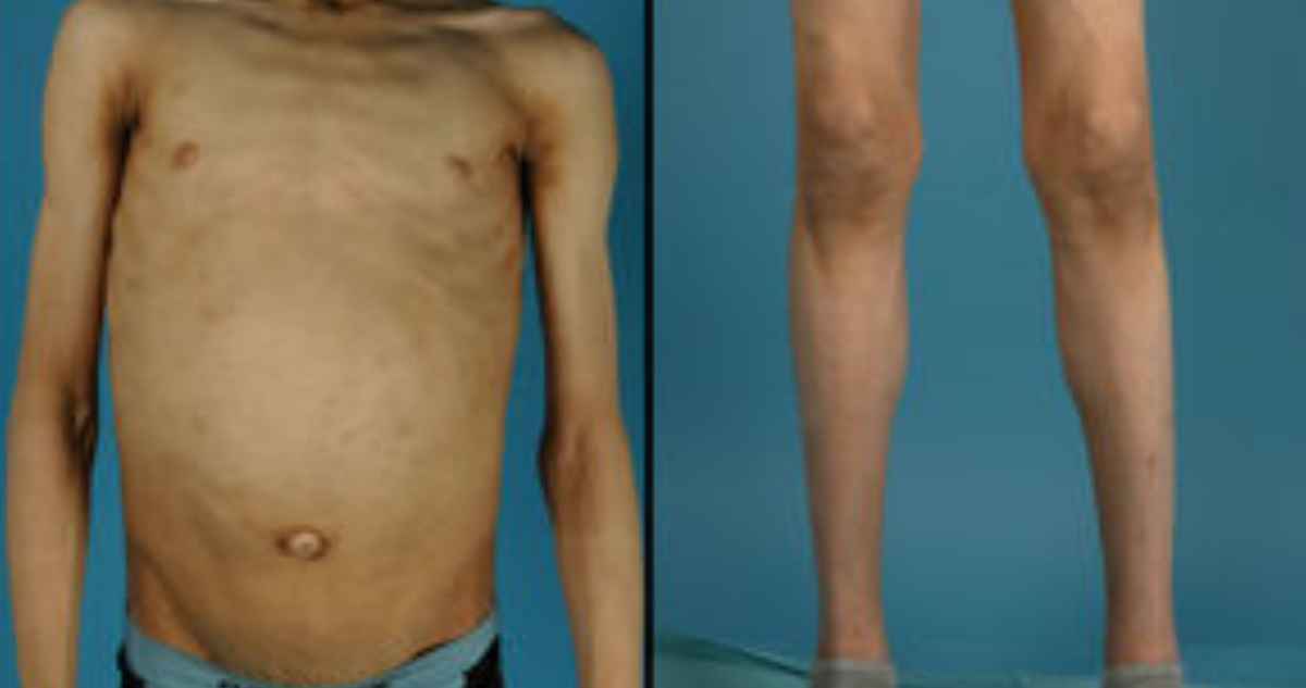 Lipodistrofia