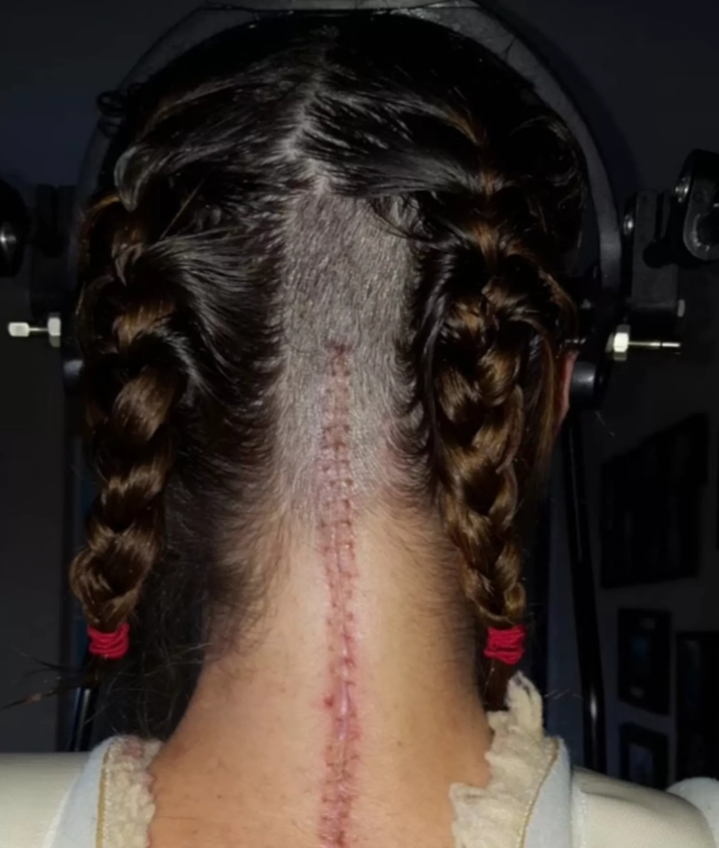 Mujer sufre "decapitación" interna y médicos le reimplantaron el cráneo: queda como estatua humana