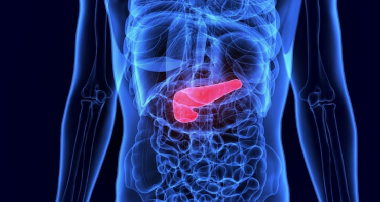 Cuáles son los síntomas del cáncer de páncreas: suele diagnosticarse en etapas avanzadas