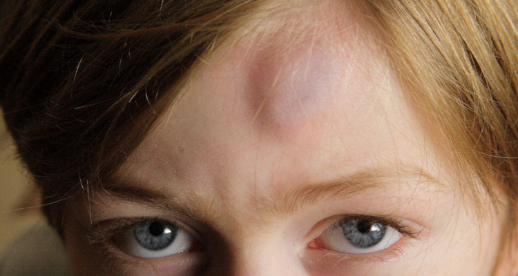 Mitos y verdades sobre golpes en la cabeza: lo que debes saber para proteger al resto según neuróloga