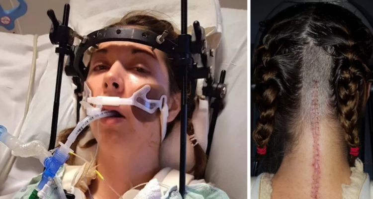 Mujer sufre “decapitación” interna y médicos le reimplantaron el cráneo: queda como estatua humana