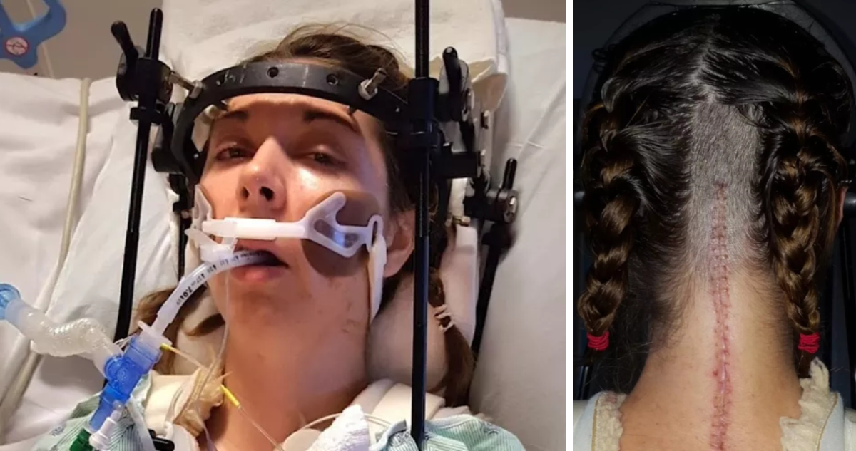 Mujer sufre “decapitación” interna y médicos le reimplantaron el cráneo: queda como estatua humana