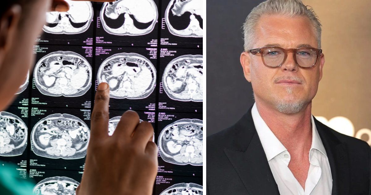 Qué es la Esclerosis lateral amiotrófica o ELA, la enfermedad neurodegenerativa de Eric Dane, cuáles son sus síntomas, tratamiento y causas.