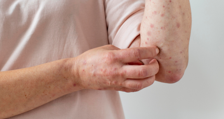 Cuáles son los síntomas del sarampión: en Chile no hay casos, pero EE.UU tuvo 2 muertes en marzo