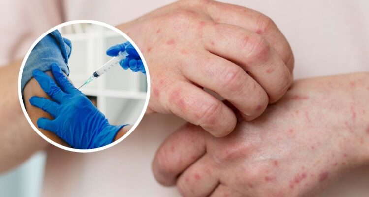 Vacuna del herpes zóster varicela contra la demencia en mujeres