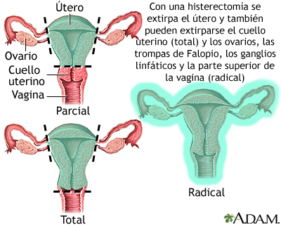 Histerectomía Bono PAD