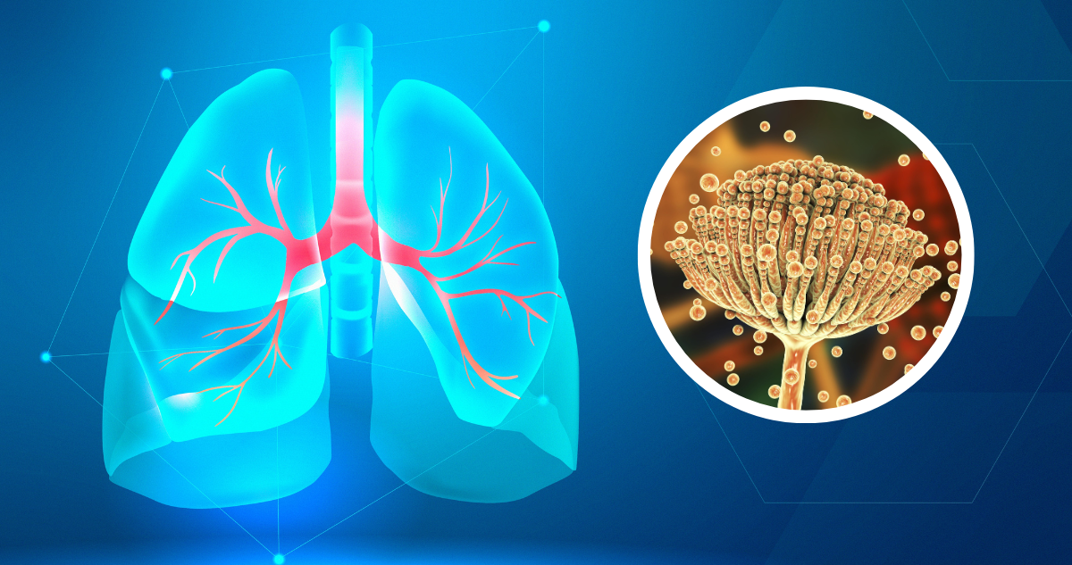 Aspergilosis pulmonar, la enfermedad provocada por hongo que afectó al Hospital El Pino
