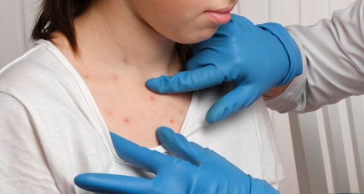 Brote de sarampión en Estados Unidos supera los 1.000 casos confirmados: se registran 3 muertes