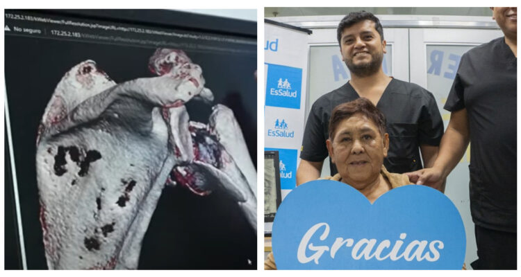 Mujer recibe hombro biónico en Perú