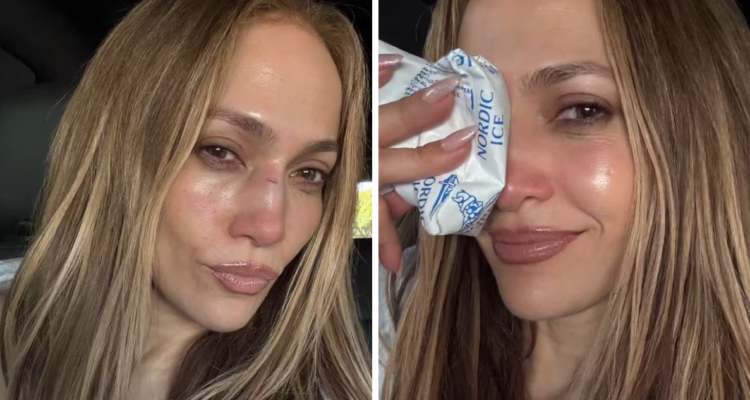 Jennifer López se accidenta durante ensayo y se parte la nariz: cirujano hizo desaparecer la cicatriz