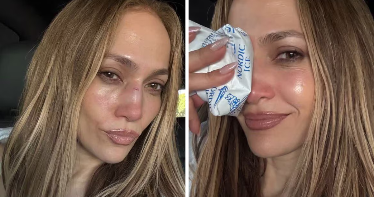 Jennifer López is accidious for essay and the nose is split: Surgeon made the scar disappear