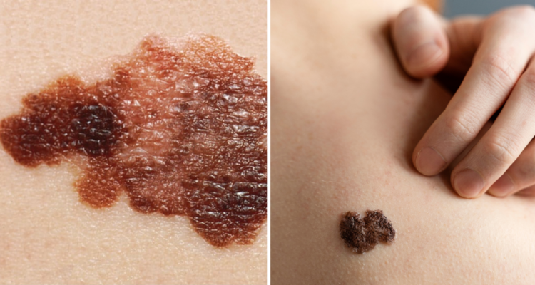 Día Mundial del Melanoma: en qué consiste la enfermedad y por qué es importante fijarse en los lunares