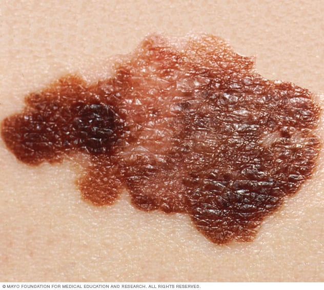Día Mundial del Melanoma: en qué consiste la enfermedad y por qué es importante fijarse en los lunares