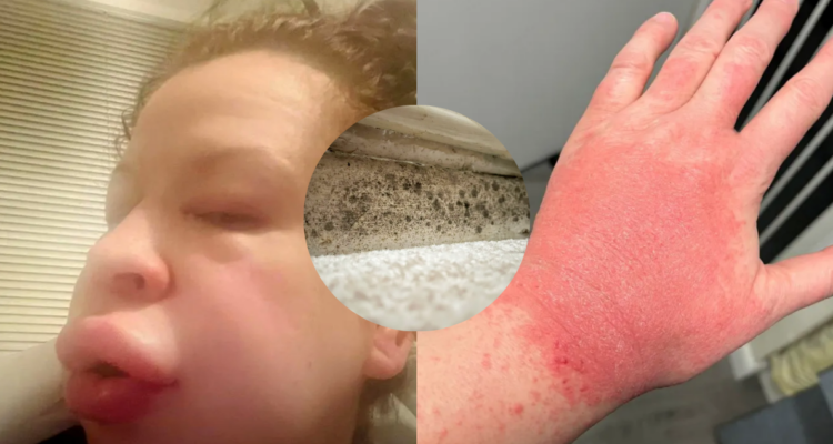 Tras una reacción alérgica “aguda” una mujer terminó en urgencias: su departamento tenía moho “negro”