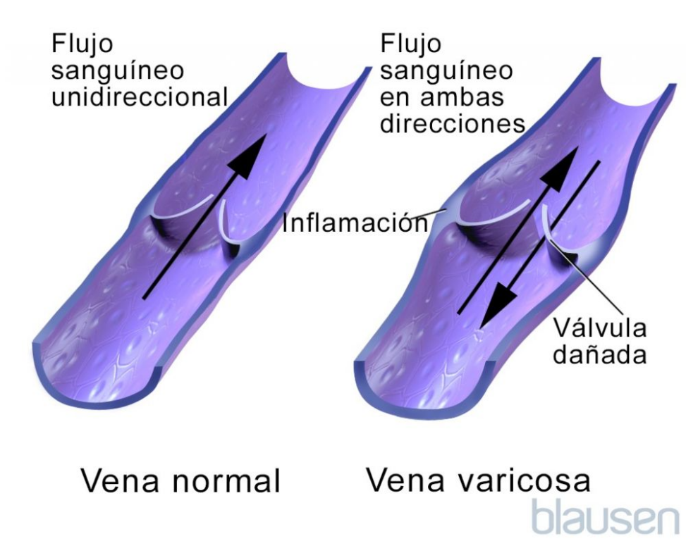 Venas varicosas o várices