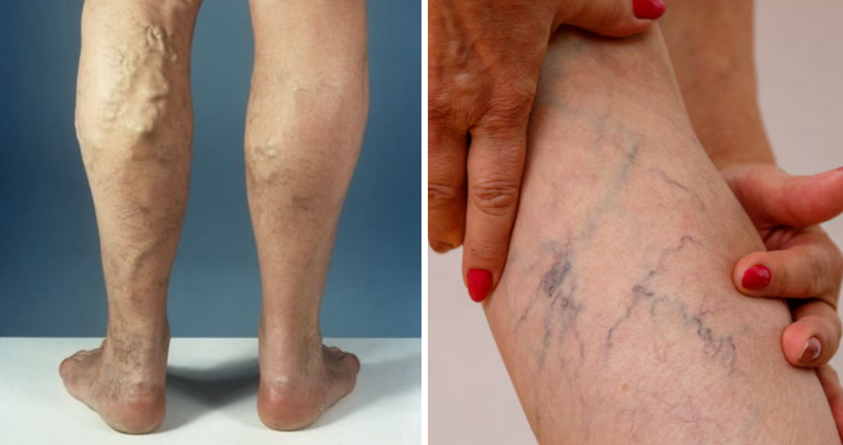 Cuándo son peligrosas las várices en las piernas y cómo prevenirlas, ¿se pueden eliminar?