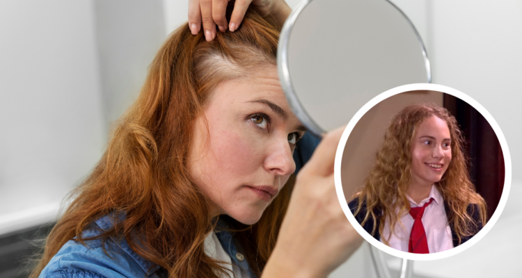 Alopecia: la condición que padece la actriz Li Fridman y que sería cada vez más común en mujeres