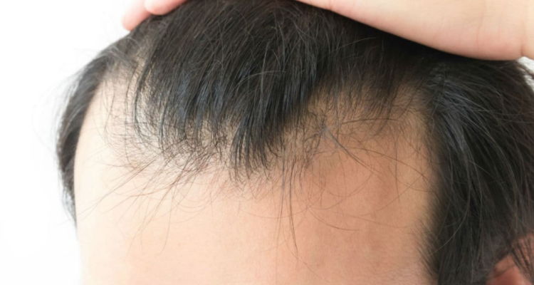 Alopecia masculina