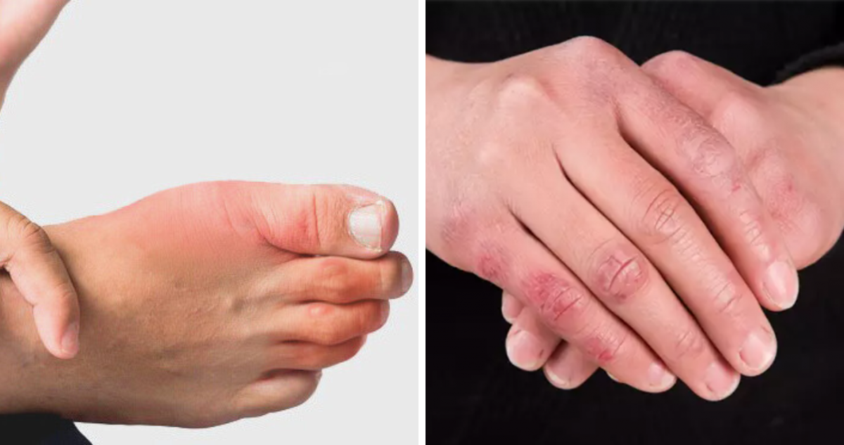 ¿Cómo prevenir los molestos y dolorosos sabañones en épocas de frío?