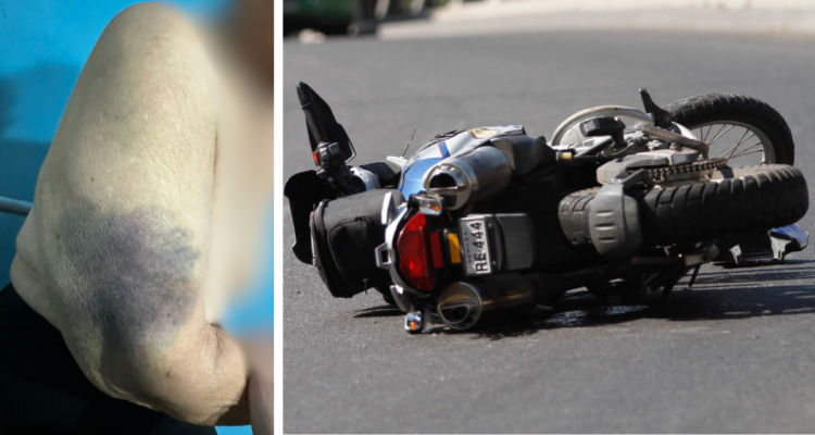 Mujer de 86 años sufre múltiples fracturas tras atropello de motociclista en Maule: debe ser operada