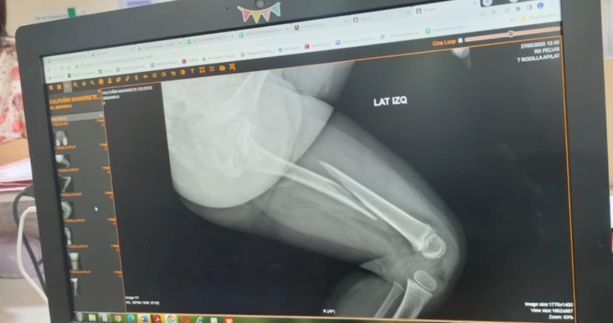 Niña termina con fractura de fémur en jardín Integra
