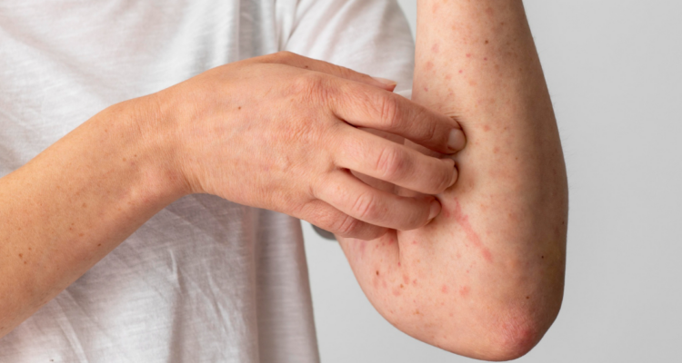 Persona con reacción alérgica cutánea en referencia al origen de la lepra en América. Imagen ilustrativa