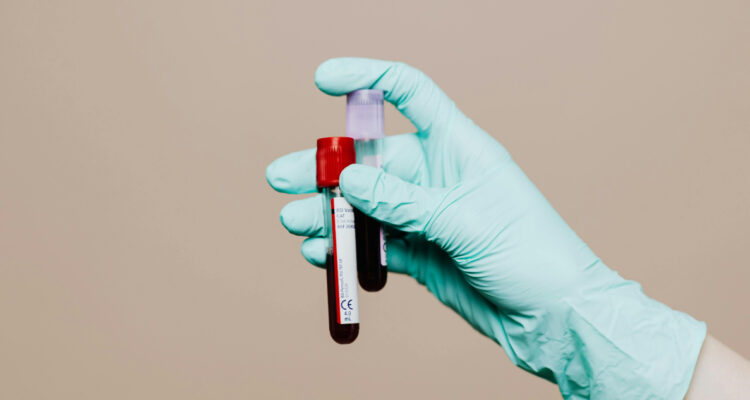 Foto de una muestra de sangre para ilustrar nota sobre nuevo grupo sanguíneo
