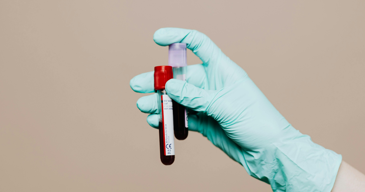 Foto de una muestra de sangre para ilustrar nota sobre nuevo grupo sanguíneo