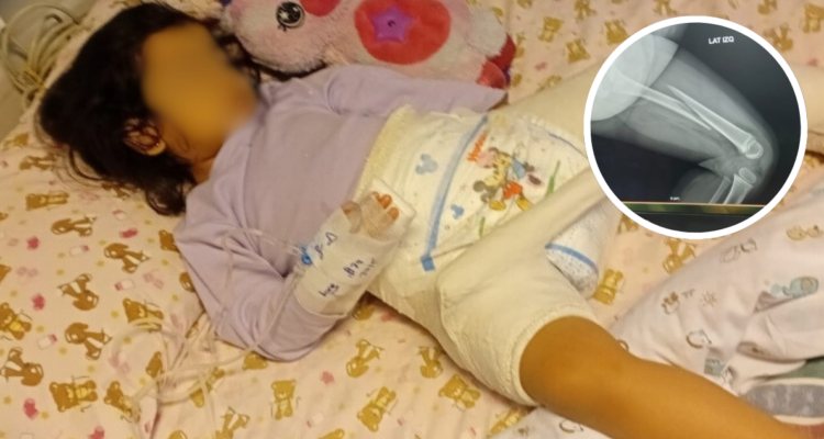 Niña se fracturó el fémur en jardín de La Araucanía y el recinto habría dicho que solo fue un golpe