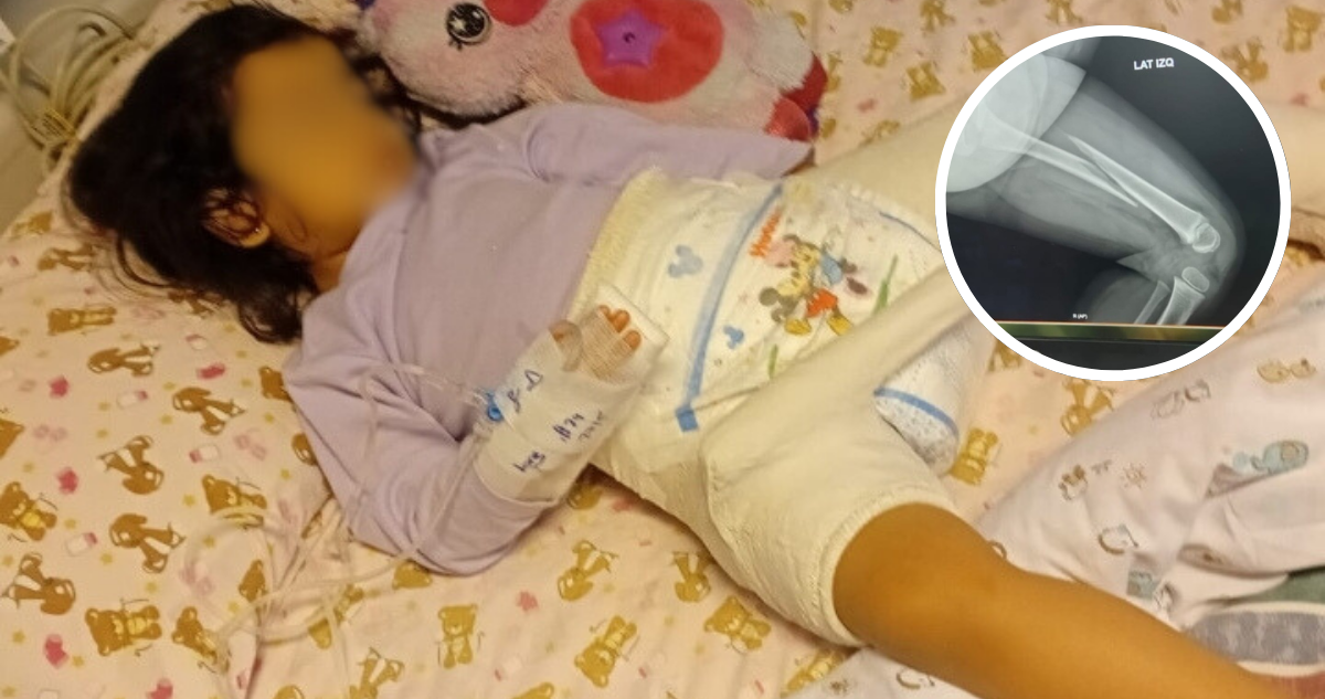 Niña se fracturó el fémur en jardín de La Araucanía y el recinto habría dicho que solo fue un golpe