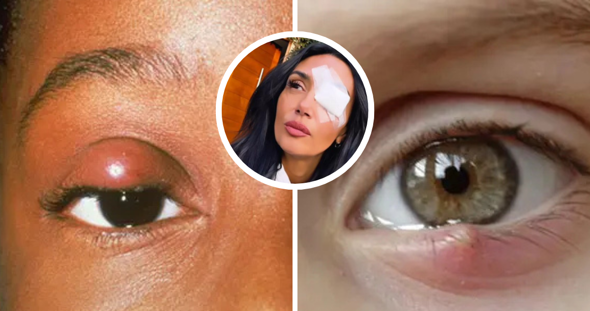 Tras diagnóstico de Pamela Díaz: ¿Qué es un chalazión y en qué se diferencia de un orzuelo?