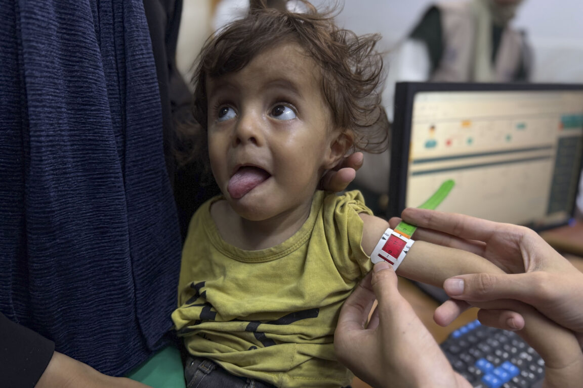 Niña con desnutrición por hambruna en Gaza