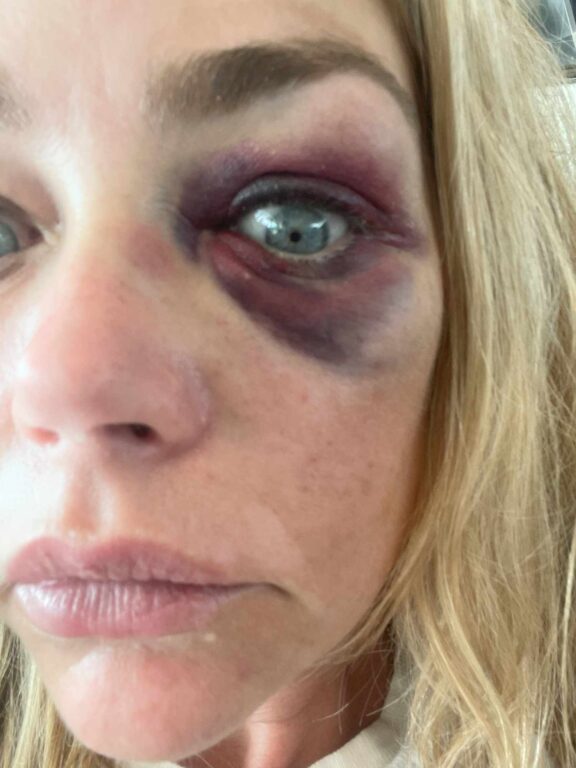 Fotografía de Denise Richards con un moretón en el ojo