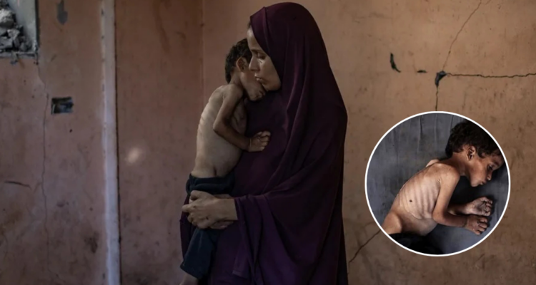 Otro niño muere de hambre en Gaza: alertan que hay 70.000 más con desnutrición clínica
