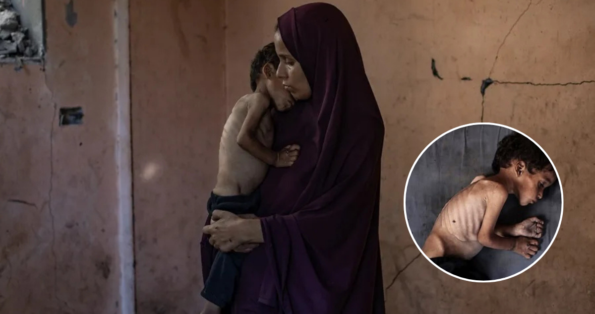 Otro niño muere de hambre en Gaza: alertan que hay 70.000 más con desnutrición clínica