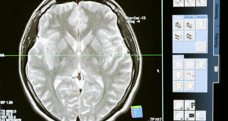 Estudio encontró que la pandemia envejeció nuestros cerebros más rápido (incluso si no tuviste covid)