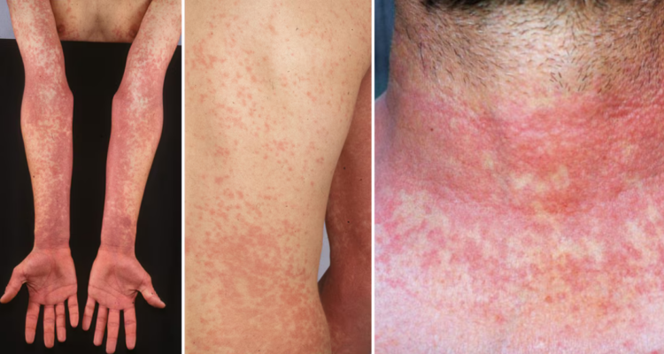 Hay cinco casos confirmados en Talca: qué es la fiebre escarlatina y cómo se contagia