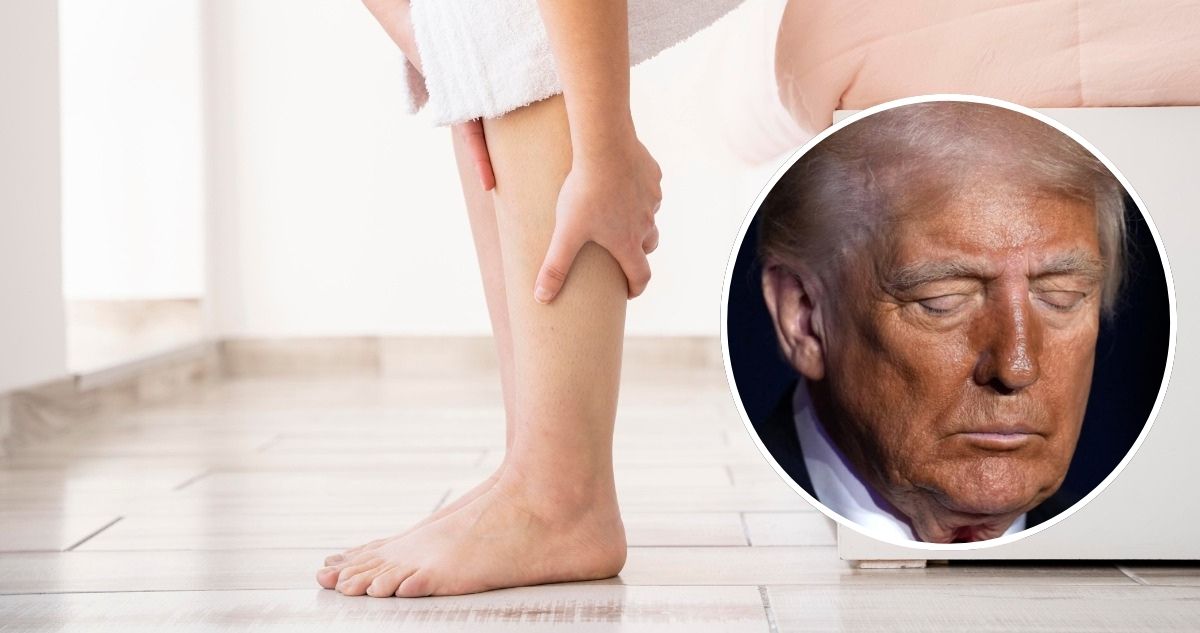 Afectó a Donald Trump: qué es la insuficiencia venosa crónica y cuándo debes acudir al médico