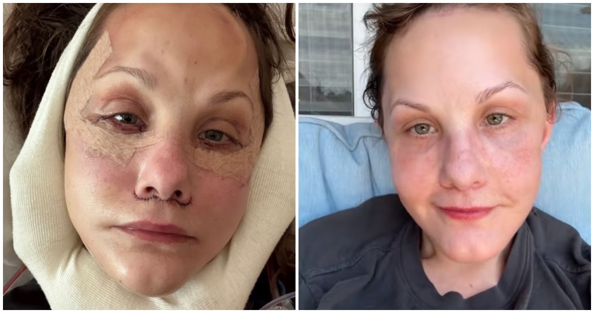 Estadounidense de 50 años se hace viral tras exitosa cirugía facial en Guadalajara: ""