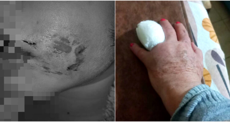 Niño de 8 años y su abuela sufren secuelas emocionales tras brutales mordeduras de hombre en la calle