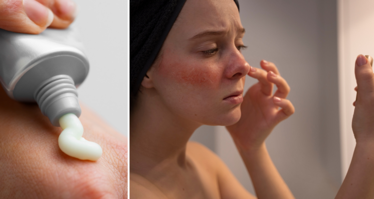 ¿Mito o realidad? Qué tan útil es la pasta de dientes para tratar las espinillas