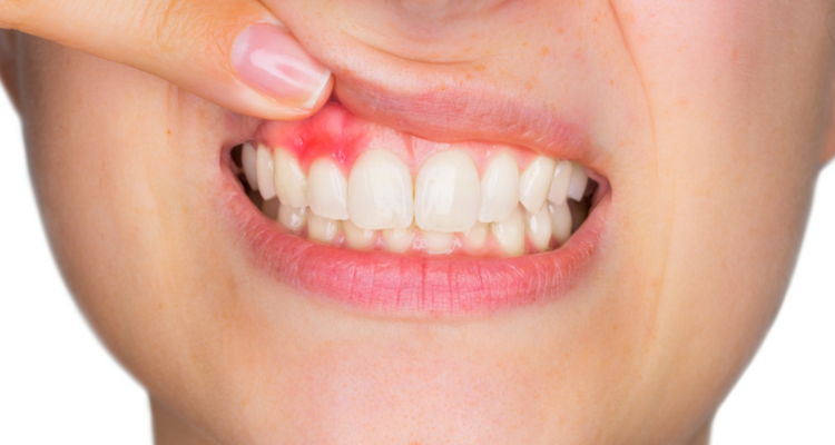 ¿Tienes sangrado de encías? Podría ser periodontitis: en qué consiste y cuáles son los síntomas