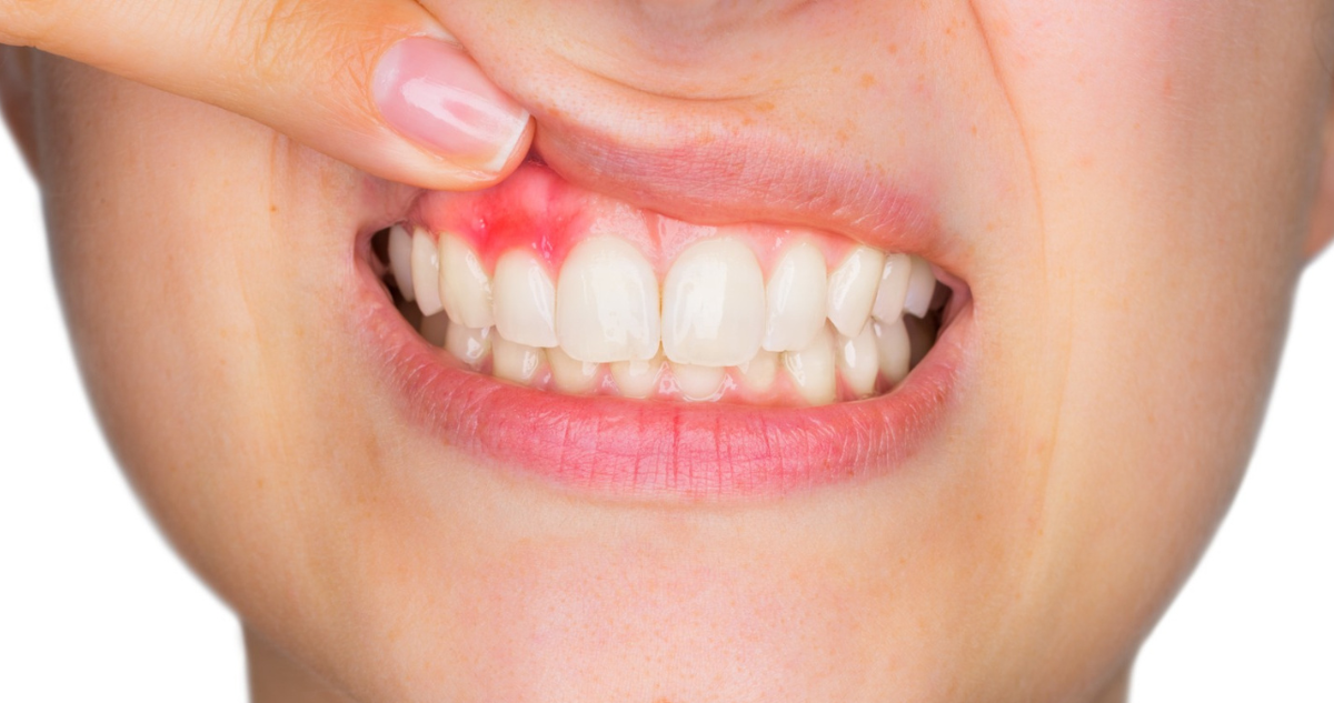 ¿Tienes sangrado de encías? Podría ser periodontitis: en qué consiste y cuáles son los síntomas