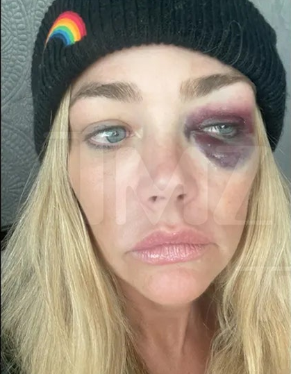 Denise Richards y golpe en su ojo que le habría propinado su exesposo