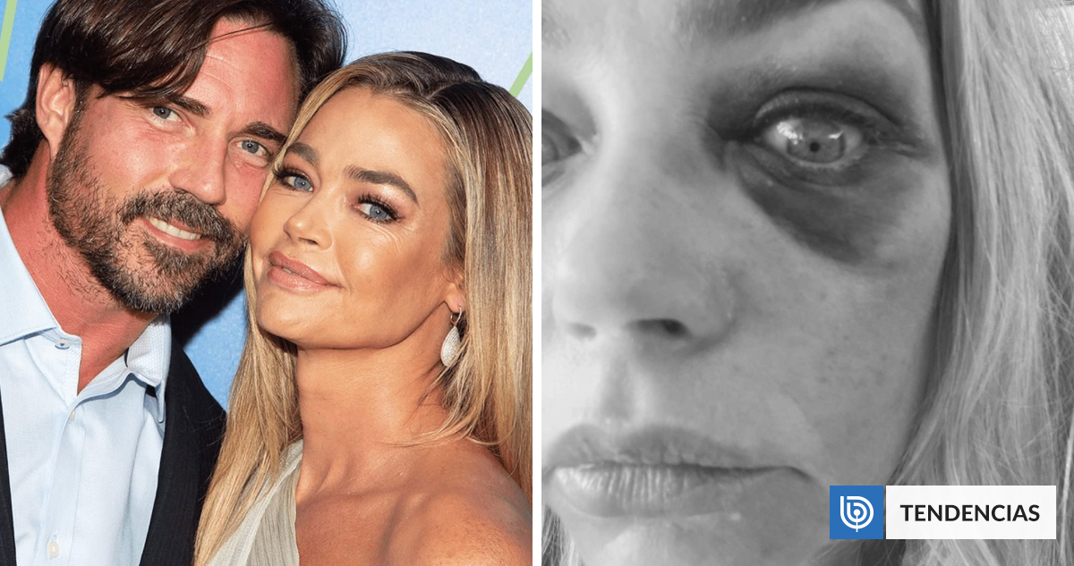 Denise Richards, de ’Scary Movie’, reveló fotografías tras ser golpeada por su exesposo: él lo negó
