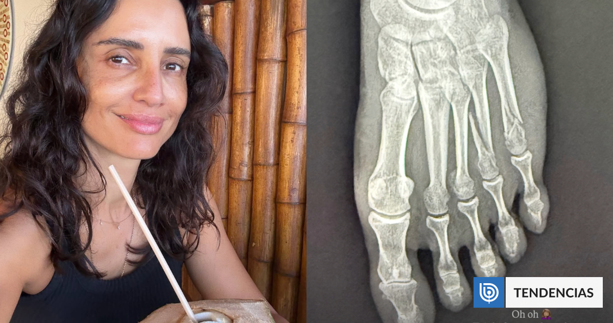 Leonor Varela sufrió severo accidente que la dejó con triple fractura de hueso: 