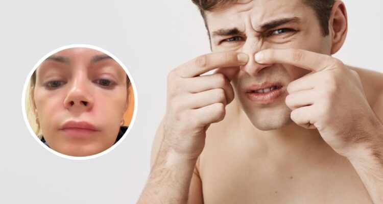 Mujer sufre grave infección por apretar espinilla en el triángulo de la muerte